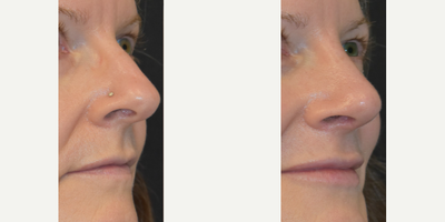 Dermal Fillers before and after photo