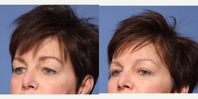 Eyelid Surgery before and after photo