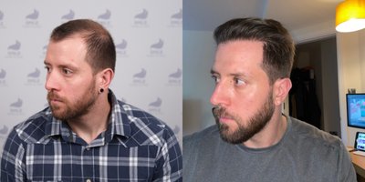 Hair Loss Treatment before and after photo