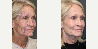 Laser Resurfacing before and after photo