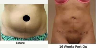 Liposuction before and after photo