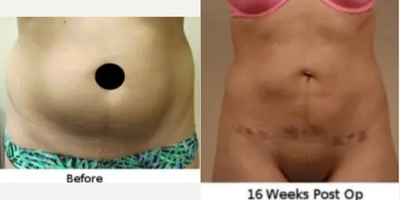 Liposuction before and after photo