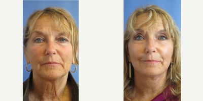 Lower Facelift before and after photo