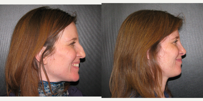 Rhinoplasty before and after photo