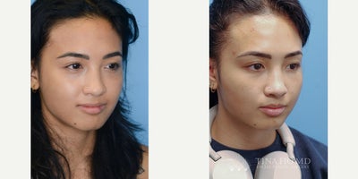 Facial Fat Transfer before and after photo