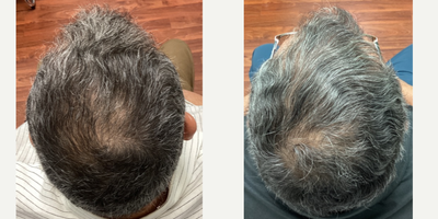 PRP for Hair Loss before and after photo
