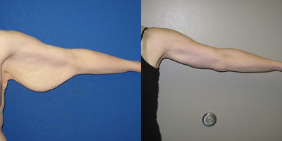 Arm Lift before and after photo