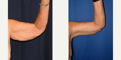 Arm Lift before and after photo