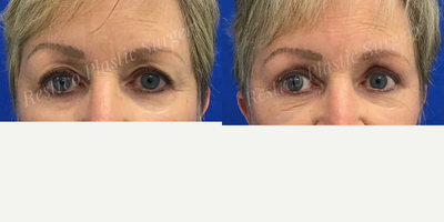 Eyelid Surgery before and after photo
