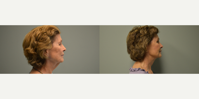 Facelift before and after photo