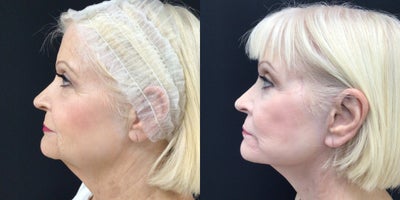 Facelift before and after photo