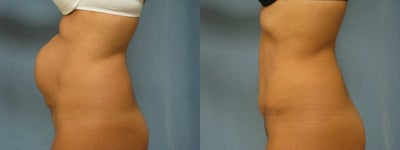 Tummy Tuck before and after photo