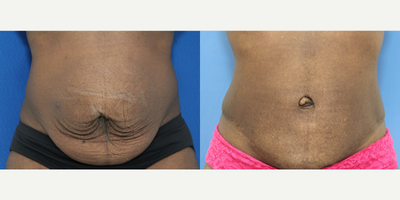Tummy Tuck before and after photo
