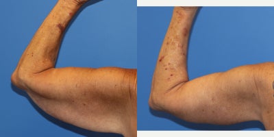 Arm Lift before and after photo