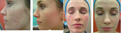 CO2 Laser before and after photo