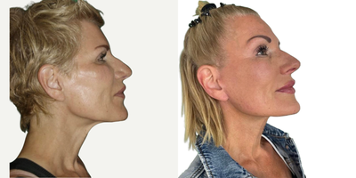 Deep Plane Facelift before and after photo