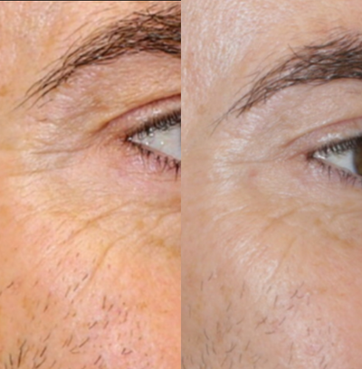 Dermal Fillers before and after photo