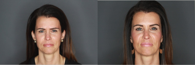 Dysport before and after photo