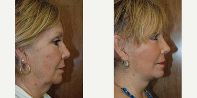 Laser Resurfacing before and after photo