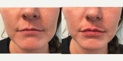 Lip Fillers before and after photo