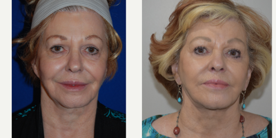 Neck Lift before and after photo