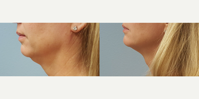 BodyFX before and after photo