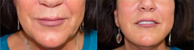 Dermal Fillers before and after photo