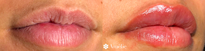 Dermal Fillers before and after photo