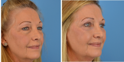 Eyelid Surgery before and after photo