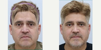 Eyelid Surgery before and after photo