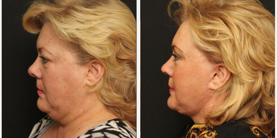 Facelift before and after photo