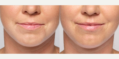Restylane Silk before and after photo