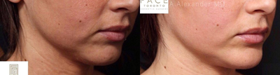 Chin Implant before and after photo