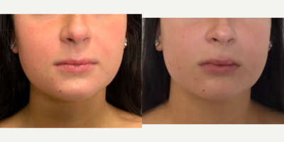 Lip Fillers before and after photo