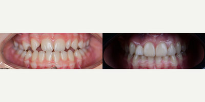 Smile Makeover before and after photo