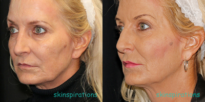 Thread Lift before and after photo