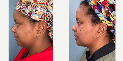 Chin Liposuction before and after photo