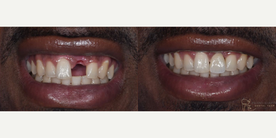 Dental Implants before and after photo