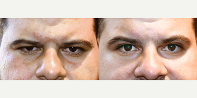 Eyelid Surgery before and after photo