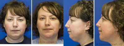 Facelift before and after photo