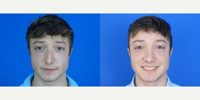 Rhinoplasty before and after photo