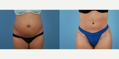 Tummy Tuck before and after photo