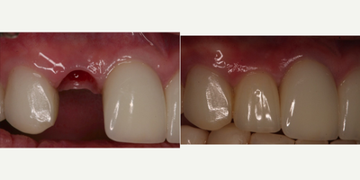 Dental Implants before and after photo