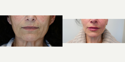 Juvederm before and after photo