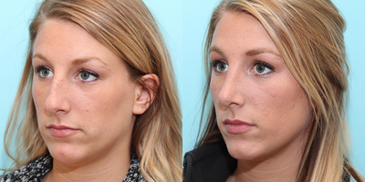 Rhinoplasty before and after photo