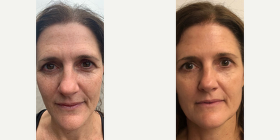 Botox before and after photo