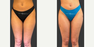 Brazilian Butt Lift before and after photo