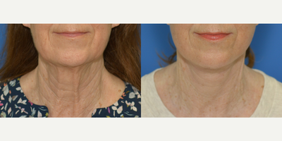 Chin Liposuction before and after photo