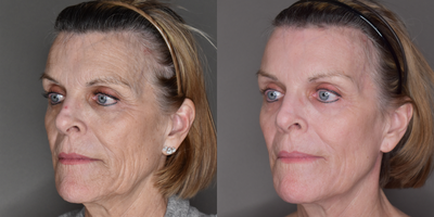 CO2 Laser before and after photo