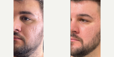 CO2 Laser before and after photo
